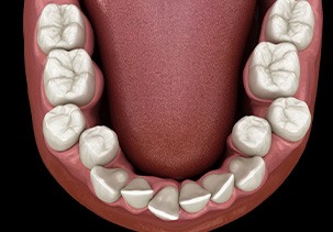 Illustration of crooked teeth