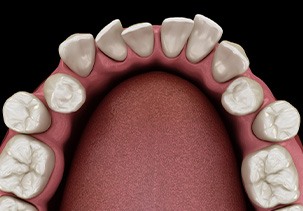 Illustration of gapped teeth