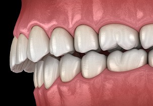 Illustration of an overbite