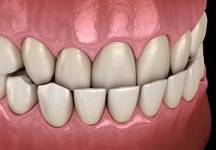Illustration of an underbite