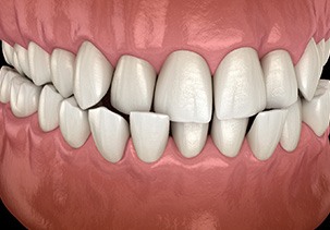 Illustration of a crossbite