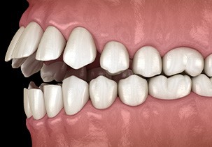 Illustration of an open bite