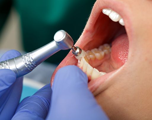 A hygienist performing a professional teeth cleaning