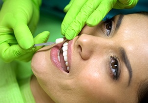a woman having a veneer placed on a tooth