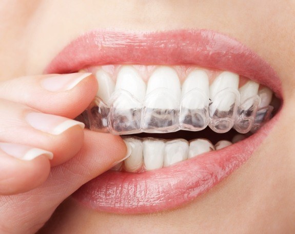 Patient placing Sure Smile clear aligner