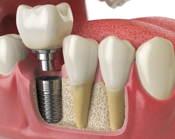 Aniamted smile during dental implant supported replacement tooth placement