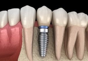 Animated smile with a dental implant supported dental crown