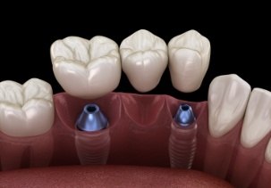 Animated smile during dental implant supported fixed bridge placement