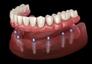 Animated smile with dental implant supported denture placement