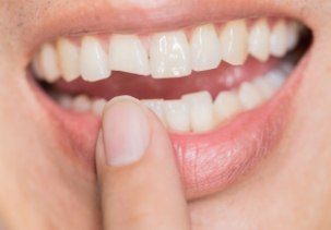 Closeup of smile with broken front tooth