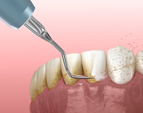 Animated smile during scaling and root planing treatment