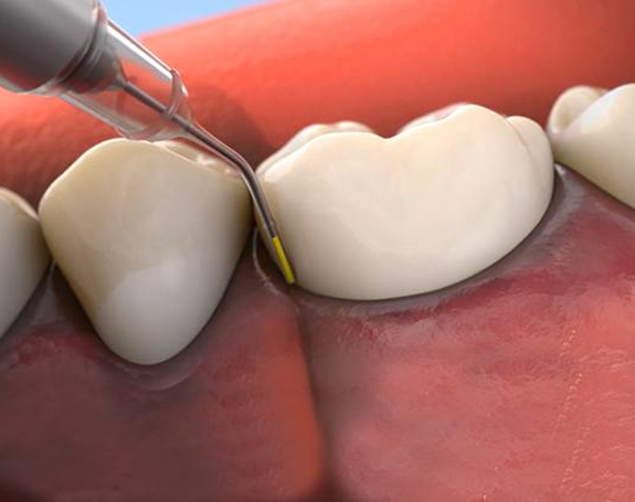 Animated smile during Arestin antibiotic therapy