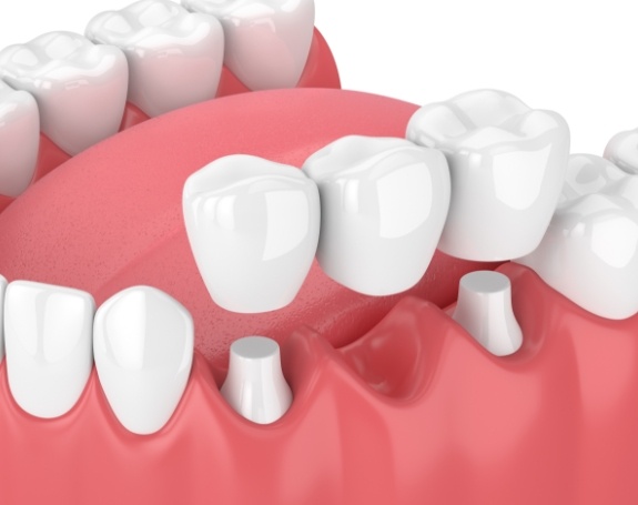 Animated smile during dental crown supported fixed bridge placement
