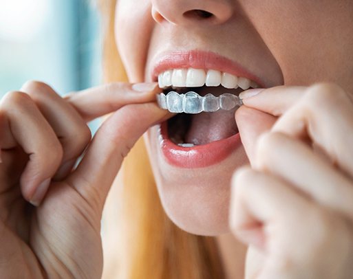 Closeup of patient placing clear aligner on top teeth