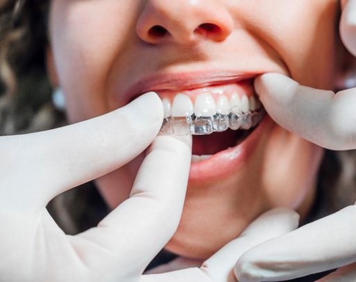 Dentist placing clear aligner on patient's teeth