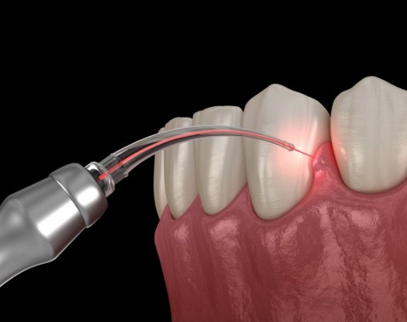 Animated smile during soft tissue laser dentistry treatment