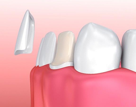 Digital illustration of veneers in Chardon