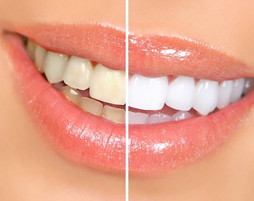 Before and after teeth whitening