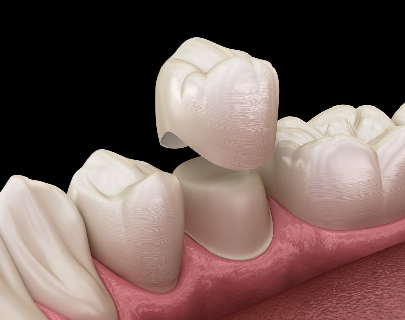 A 3D illustration of a dental crown in Chardon