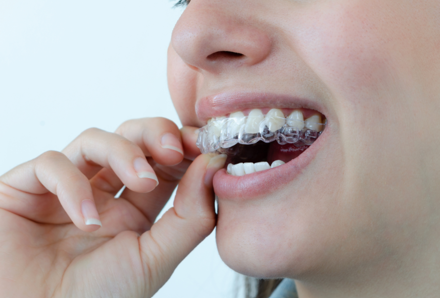 Close up of person putting clear aligner in